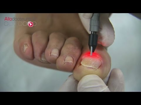 Mycoses des ongles : le traitement au laser - Allô Docteurs