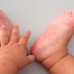 maladie pied main bouche : comment la reconnaître ?