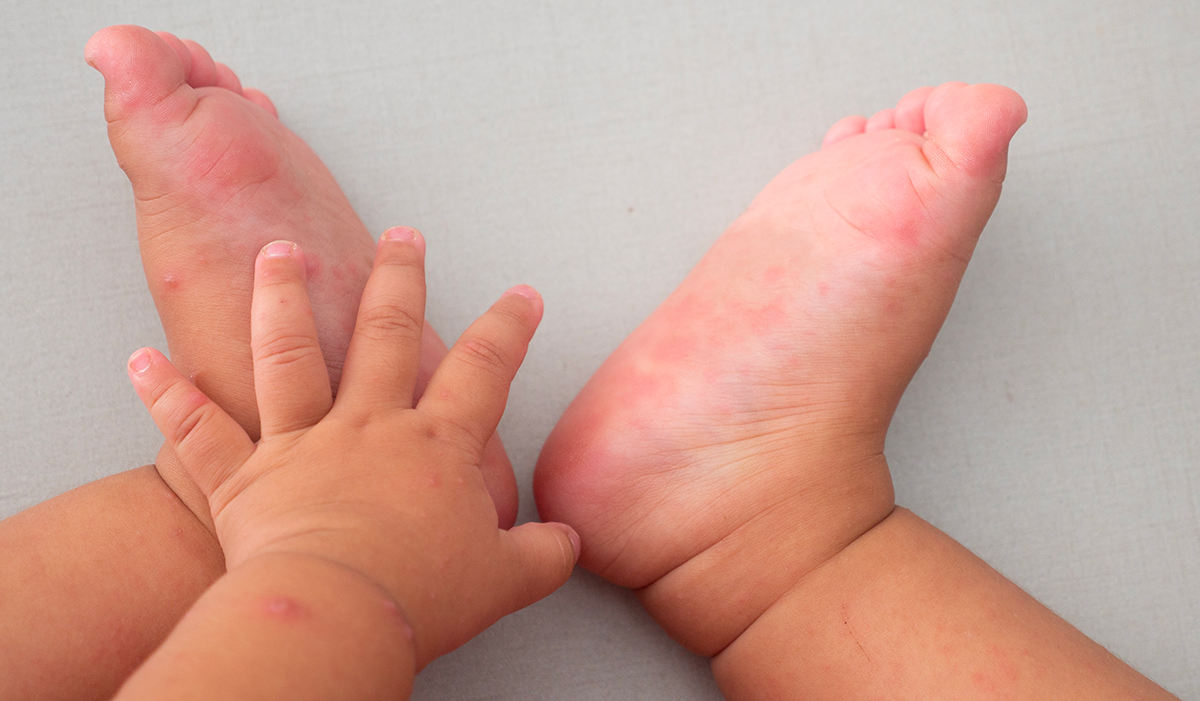 maladie pied main bouche : comment la reconnaître ?