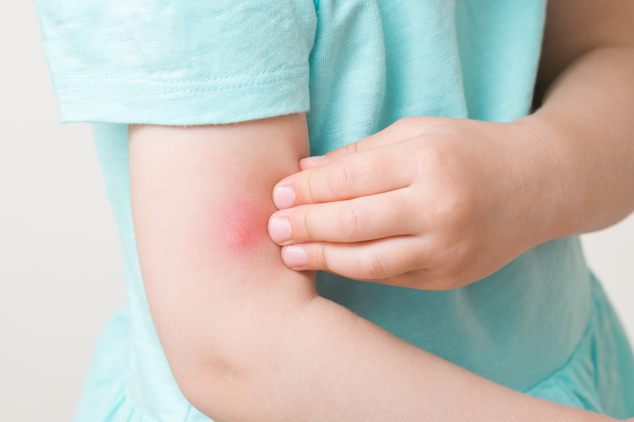 quelle solutions pour soulager les piqures de moustiques