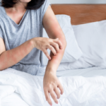 Symptômes et solutions pour les piqûres de punaises de lit